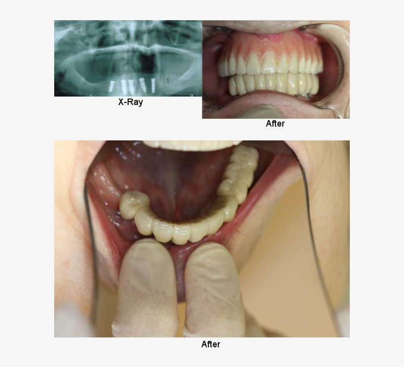 Implants Permanent Teeth Smile Gallery - Do Adult Teeth Look Like, transparent png download