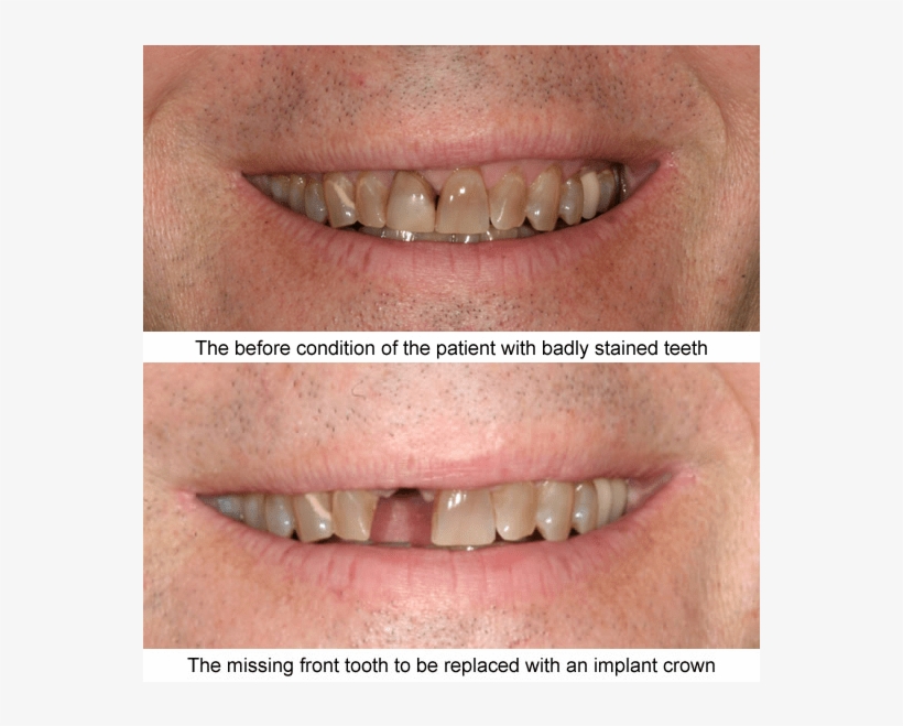 Before And After Case Examples All Of These Cases Shown - Tongue, transparent png download