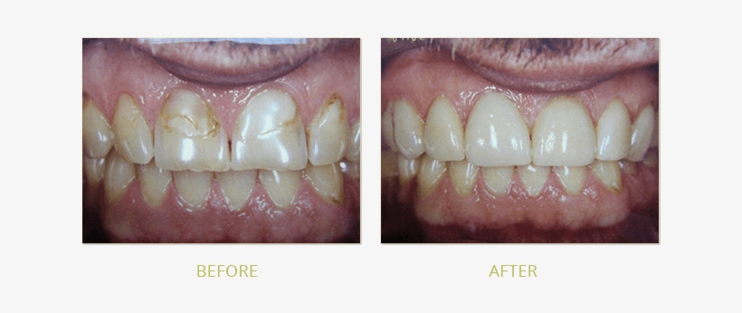 Smile Gallery Before After - Smile Gallery, transparent png download