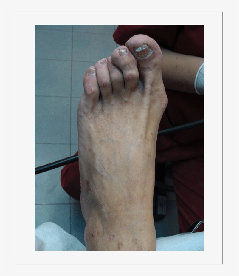 This Bone Prominence Is Highly Associated With Ulcers - Hammer Toe, transparent png download