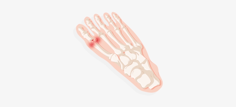 Big Toe, Making Bending Or Straightening Difficult - Illustration, transparent png download