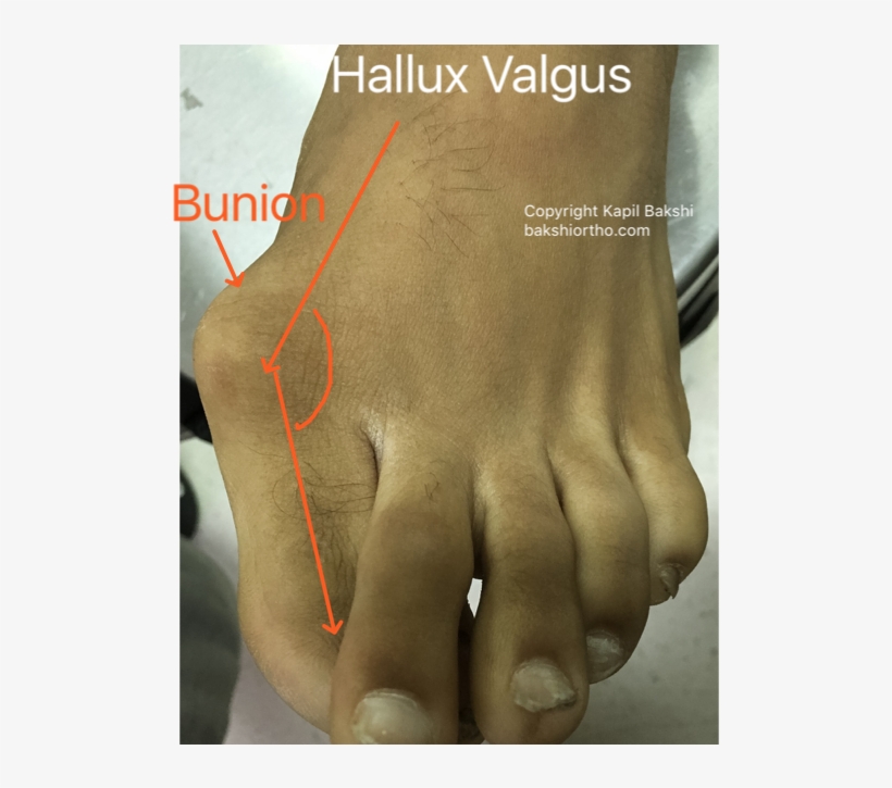 Hallux Valgus With Bunion And Overlapping Toes - Poster, transparent png download