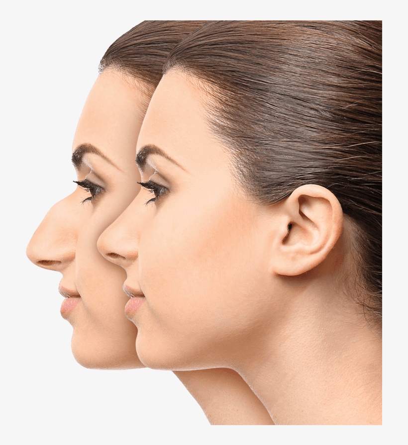 Modelos De Nariz Para Rinoplastia, transparent png download