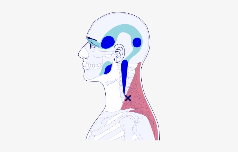 Classic “question Mark” Pain Brought About Through - Myofascial Trigger Point, transparent png download