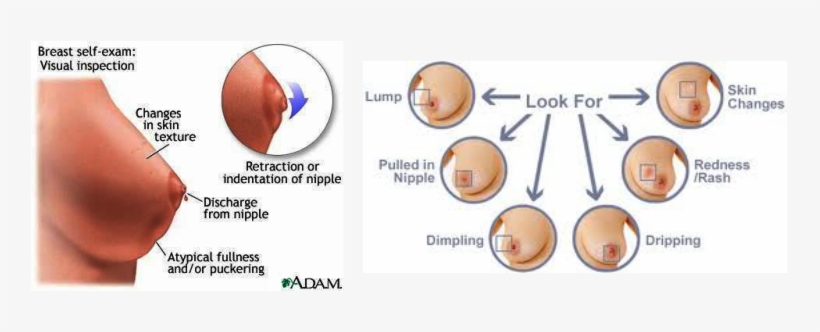 Picture - Sintomas Cancer De Mamaa, transparent png download