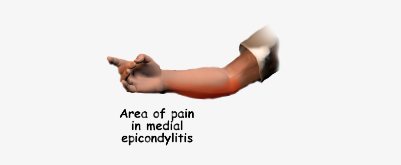 You May Feel Less Strength When Grasping Items Or Squeezing - Medial Epicondylitis Golfer's Elbow, transparent png download