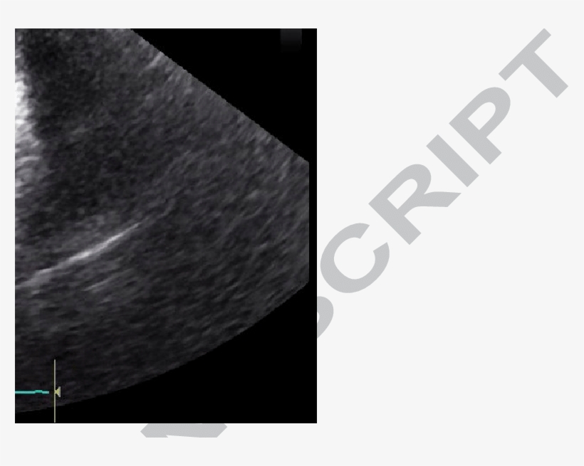 Two Masses Are Seen Here, One In The Tv And One In - Laser Ablation In Liquid, transparent png download