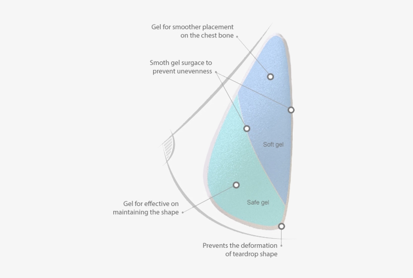 The 3rd Generation Implant Dual Chamber Teardrop - Teardrop Implant, transparent png download