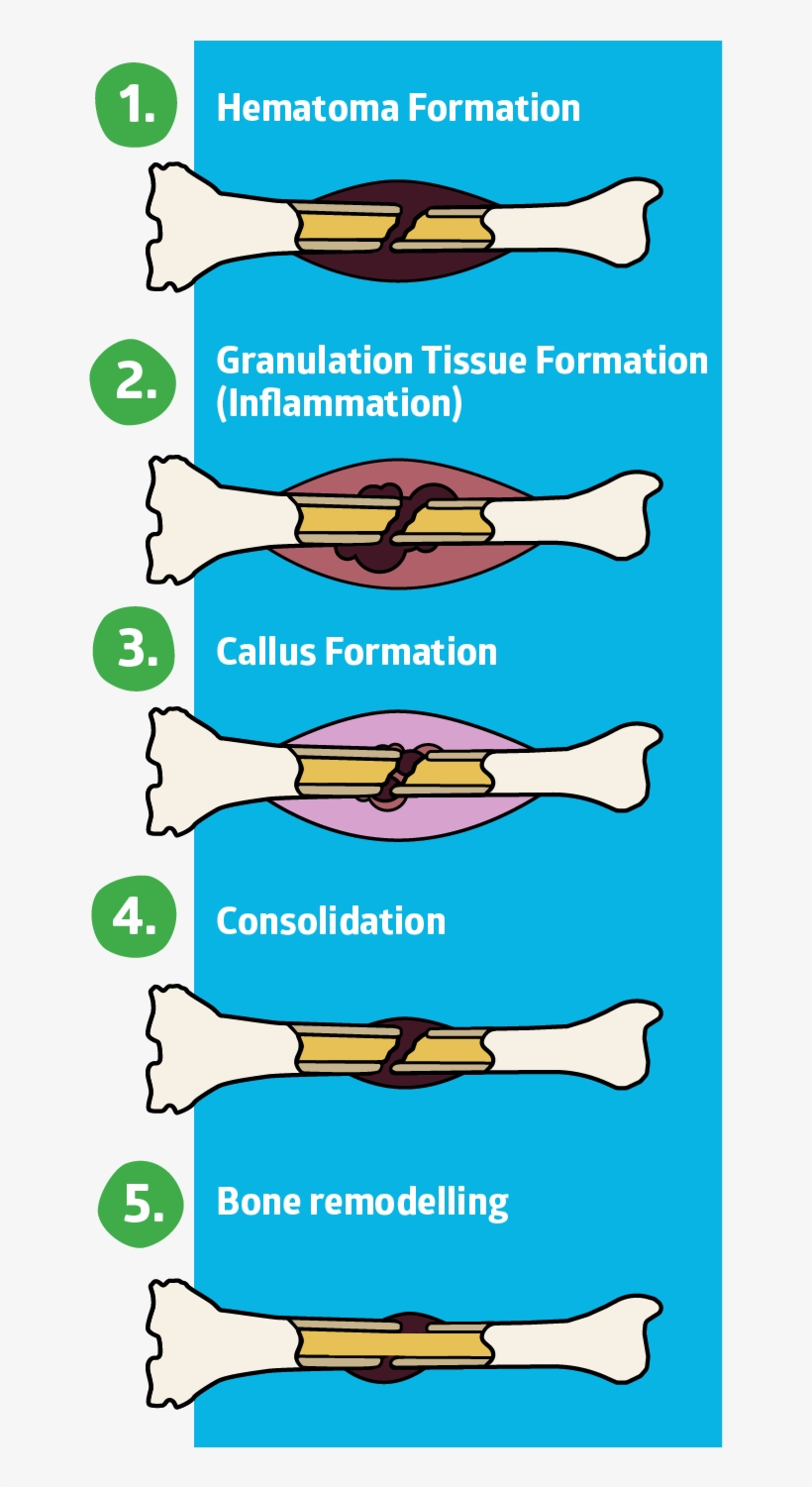 Hematoma Formation - Fracture Healing Stages, transparent png download