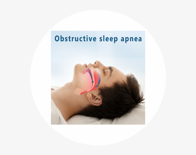 Symptoms Of Sleep Apnea - Obstructive Sleep Apnea, transparent png download