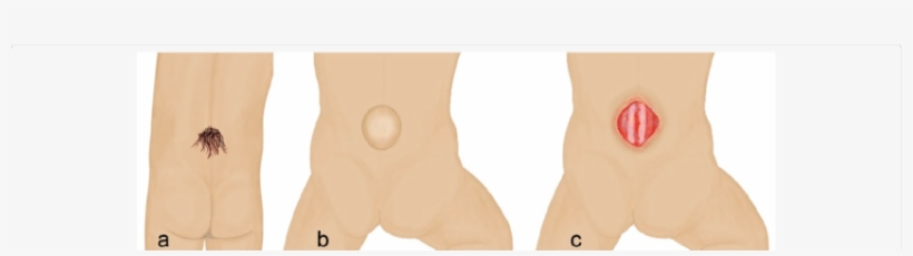 Posterior View Of Back In Spina Bifida A - Teddy Bear, transparent png download