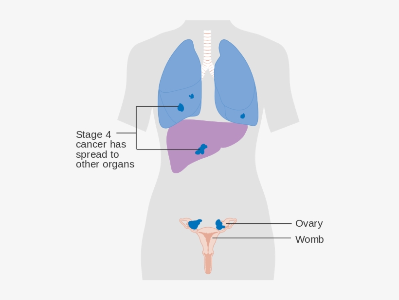 Diagram Showing Stage 4 Ovarian Cancer Cruk - Ovaries And Liver, transparent png download