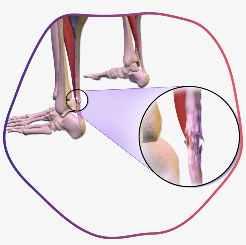 Muscle Tear - Tendon Calcification Achilles Cause, transparent png download