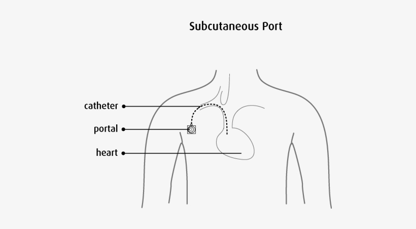 The Nurse Inserts A Special Type Of Needle Through - Subcutaneous Port Catheter, transparent png download