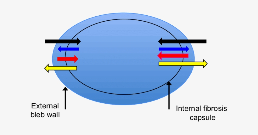 Bleb Needling Was Performed With A 30 Guage Needle - Circle, transparent png download
