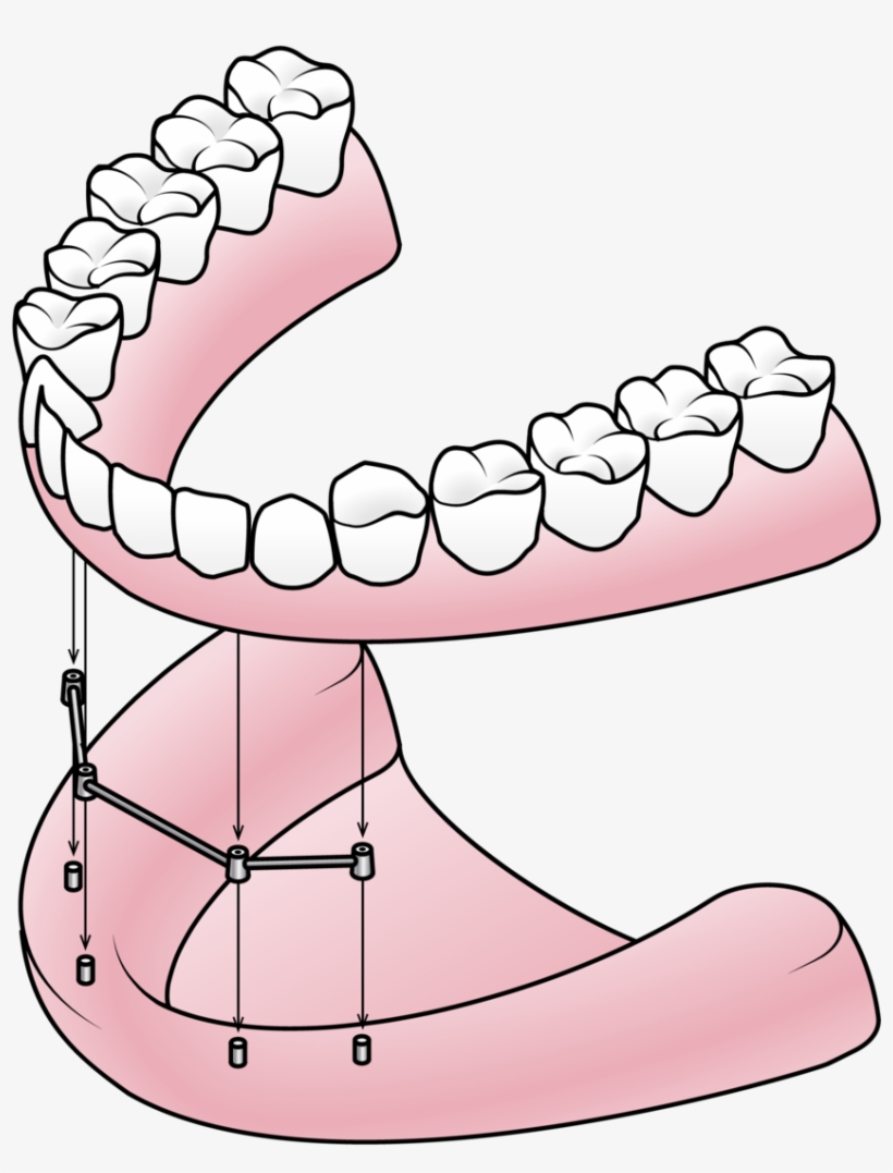 Implant-istock 51362490 Illustration - Component Of Partial Denture, transparent png download