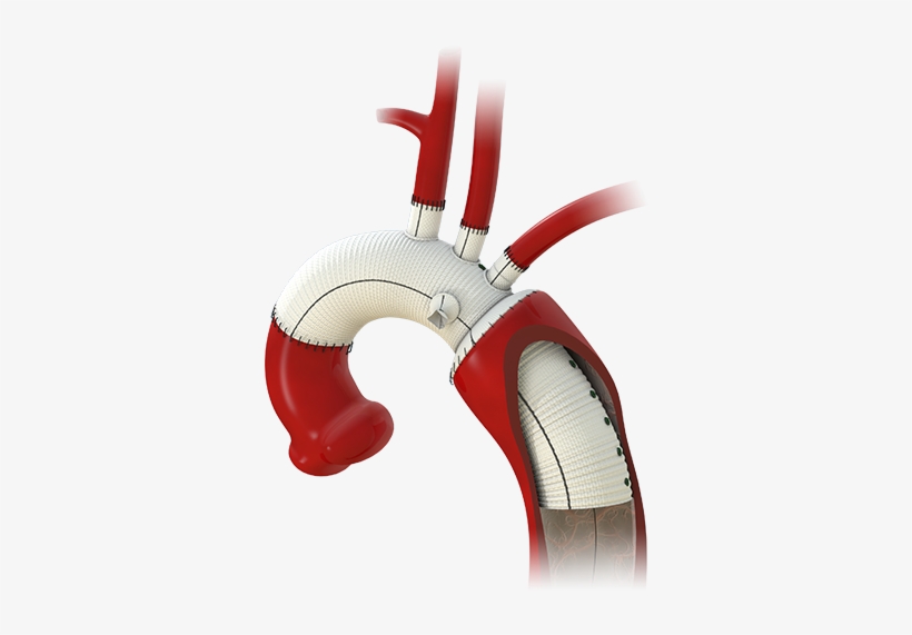 The Gelweave™ Siena Graft Used In A Modified "elephant - Siena Graft, transparent png download