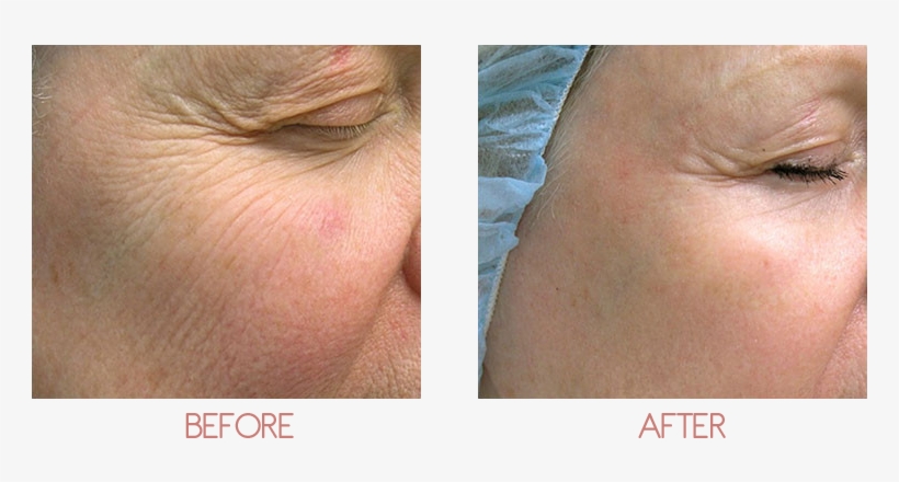 Sypien, M - Non Ablative Laser Wrinkles, transparent png download