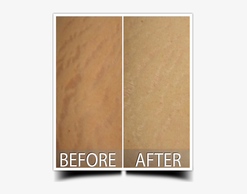 Laser Stretch Mark - Laser, transparent png download