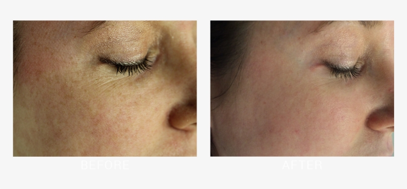 Suttonderm Beforeaftergallery Fraxel3 - Fraxel Laser, transparent png download