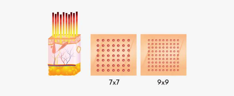 A Demonstration Of How Er - Caja De Tornillos Traumatologia, transparent png download