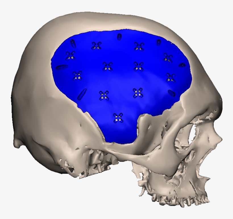 Side-psi - Cranial Prosthesis Pmma, transparent png download