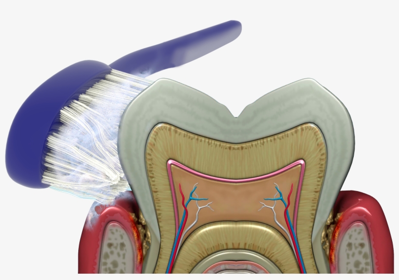 Brushing, Rinsing And Flossing Cannot Reach The Bacteria - Gingival And Periodontal Pocket, transparent png download