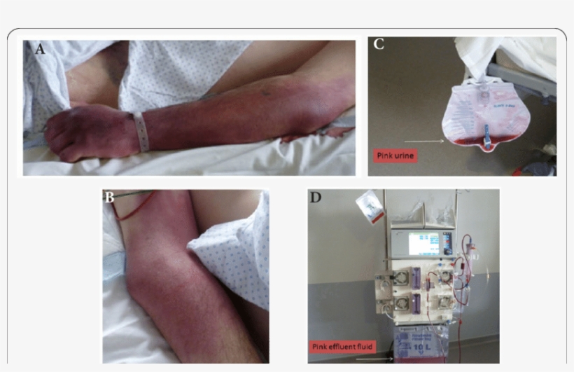 Pink Colored Skin Of The Left Forearm , Where Hydrocobalamin - Heel, transparent png download