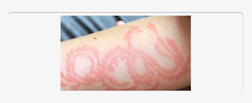 Erythema And Inflammation On The Left Forearm Of A - Inflammation, transparent png download