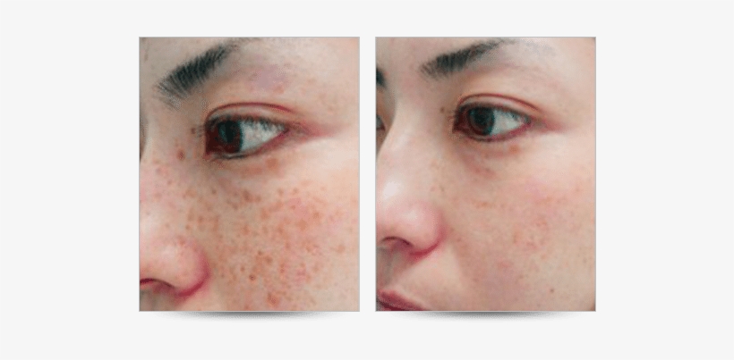 Ocean State Laser & Aesthetics, Brown Spot Removal - Apple Cider Vinegar Sunspots Before And After, transparent png download