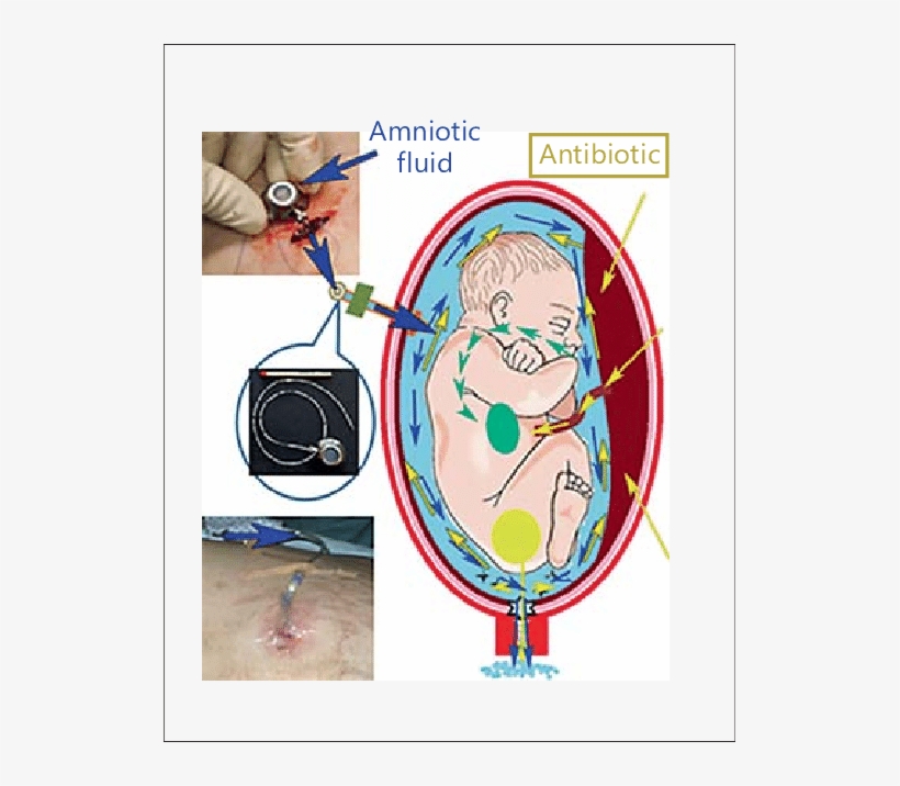 Hypoosmotic Saline Solution With Antibiotic Used To - Amnioinfusion, transparent png download