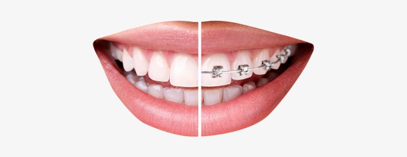 Teeth With Braces Png Transparent Image - Dientes Con Brackets, transparent png download