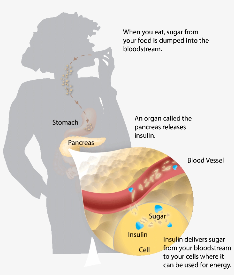 Diabetes Genetics, transparent png download