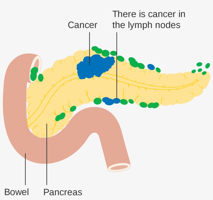 Open - Pancreatic Cancer Diagram, transparent png download