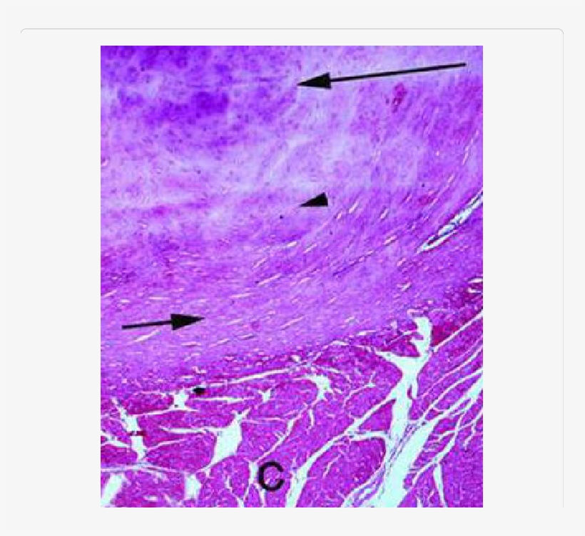 A Photomicrograph Showing The Hyaline Cartilage , Fibrous - Hyaline Ct, transparent png download