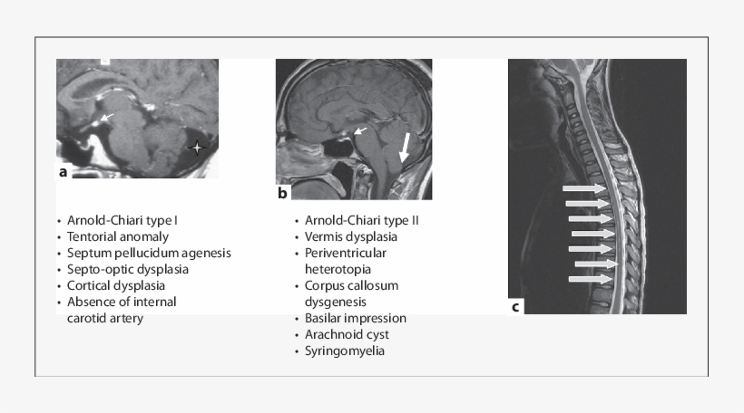 Small Arrows Showing Ectopic Posterior Pituitary In - Computed Tomography, transparent png download