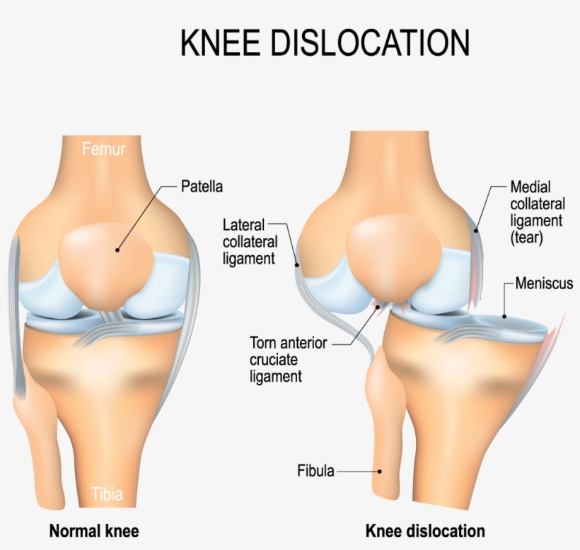 Acl Injury Physiotherapy Treatment - Knee Dislocation, transparent png download