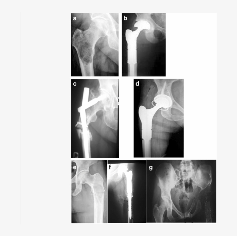 Preoperative And Postoperative Radiograms Series - Radiography, transparent png download