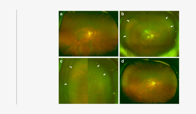 Preoperative And Postoperative Ultra Widefield Fundus - Collage, transparent png download