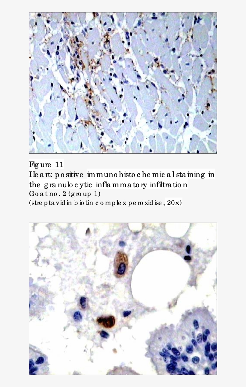 Positive Immunohistochemical Staining Of The Granulocytes - Immunohistochemistry, transparent png download