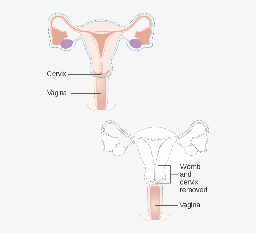 Hysterectomy, transparent png download