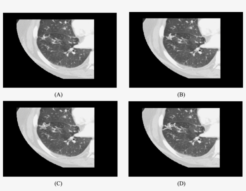 White Outline Shows Contour From Three Different Readers - Lung, transparent png download