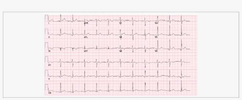 Admission Ekg With Q-waves In The Inferior Leads And - Number, transparent png download