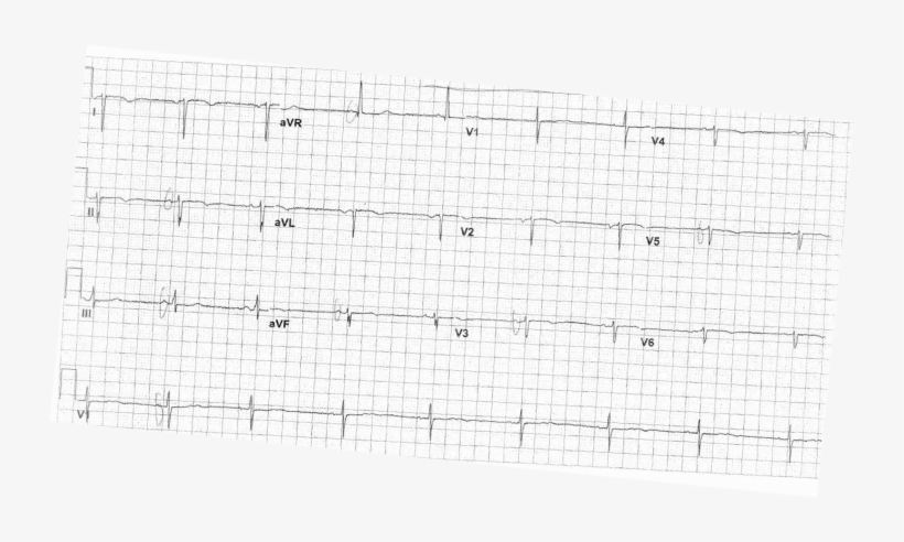This Ekg Is Not In Sinus Rhythm - Number, transparent png download