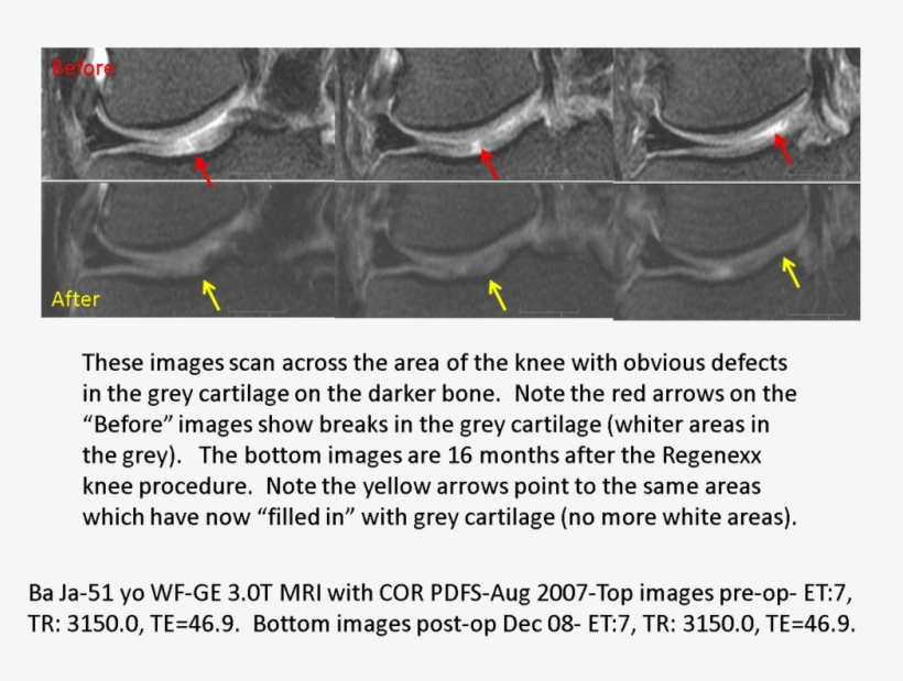 Note The Red Arrows Point To Breaks In The Cartilage - Knee, transparent png download