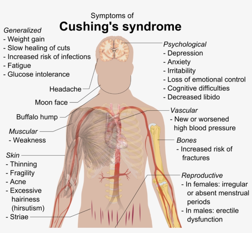 Diseases Of The Hypothalamus Pituitary Adrenal Axis - Cushing Syndrome, transparent png download