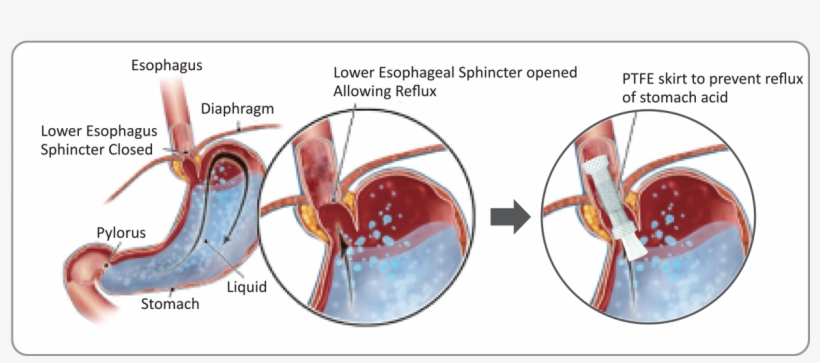 B - Anti Reflux Esophageal Stent, transparent png download