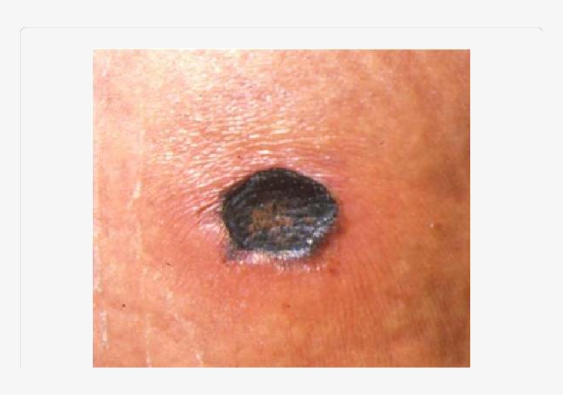 Mediterranean Spotted Fever Tache Noir, transparent png download