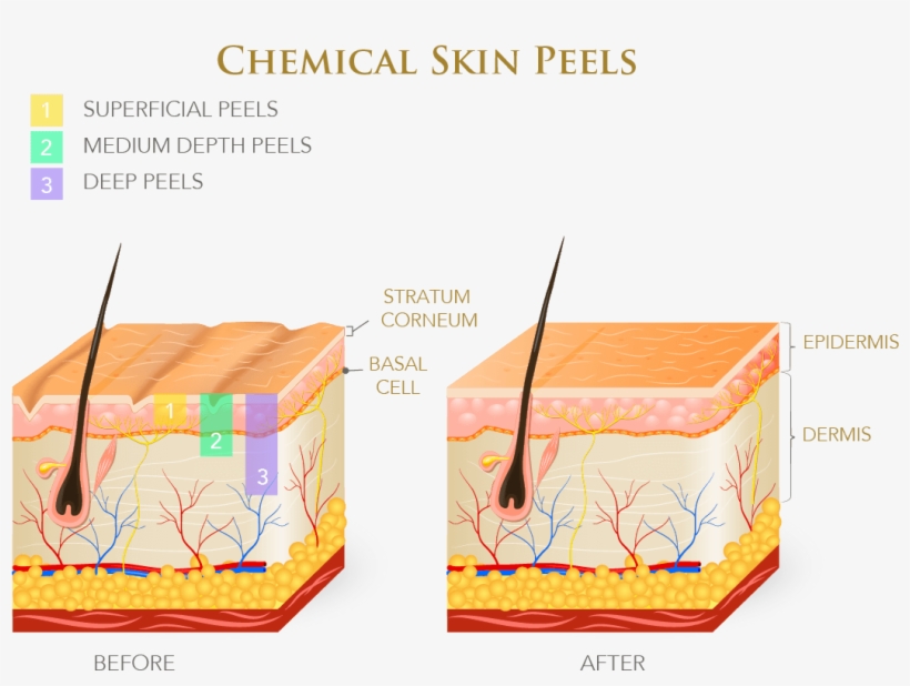 Chemical Peels Come In Different Strengths, And The - Oily & Dry Skin, transparent png download