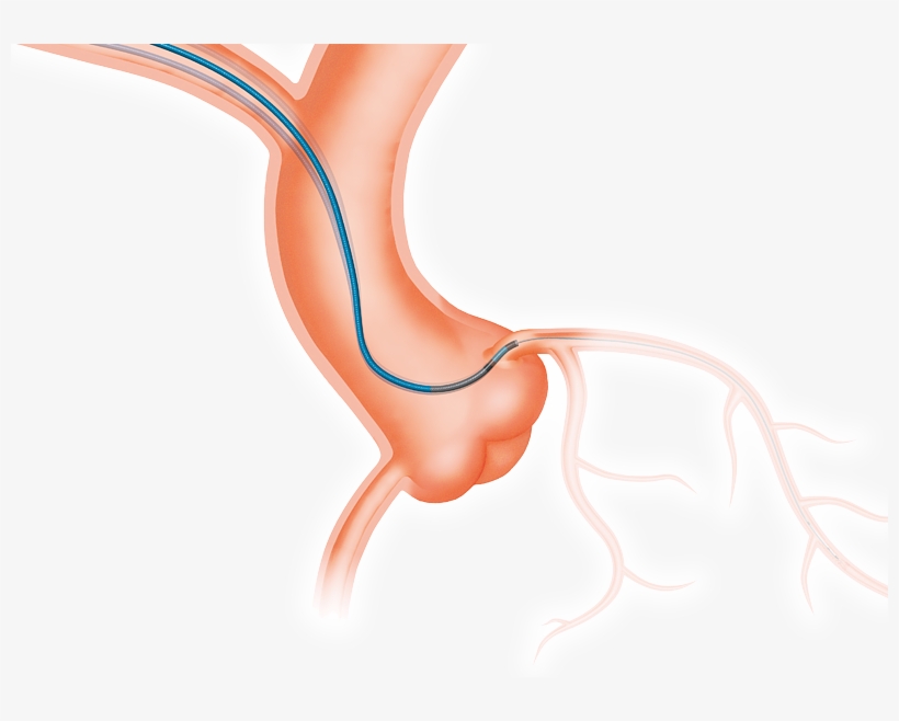 Ptca Guiding Catheter - Coronary Guide Catheters Right, transparent png download